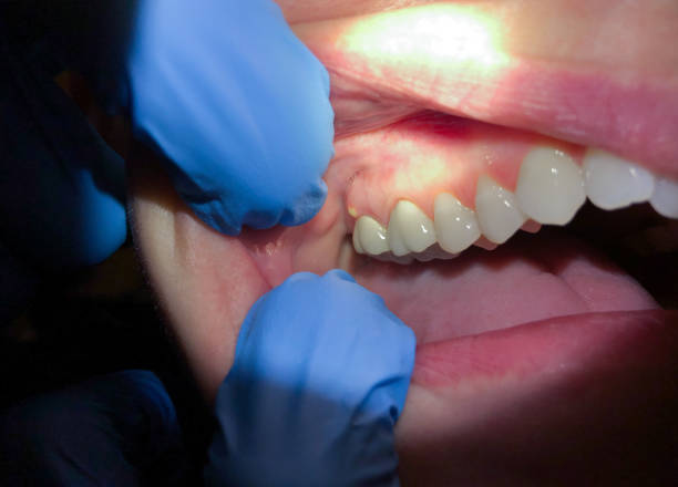 Best Emergency Dental Services for Seniors in La Honda, CA